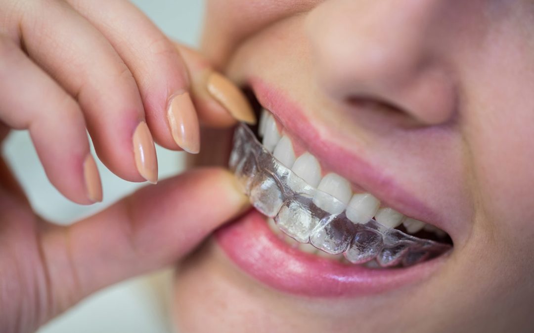 ¿Cuánto Cuesta Invisalign en Panamá?