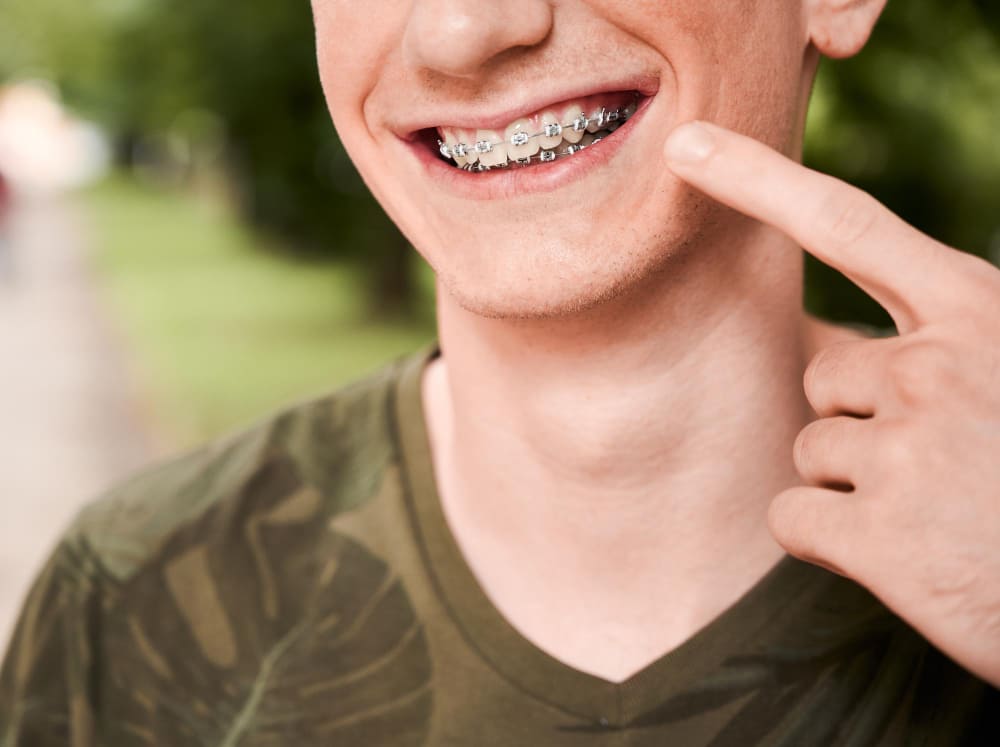 Qué alimentos evitar si tienes brackets