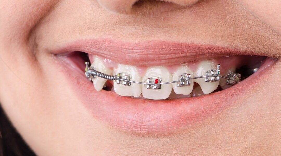 Brackets en porcelana: Estética y funcionalidad