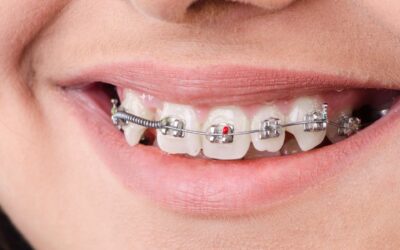 Brackets en porcelana: Estética y funcionalidad