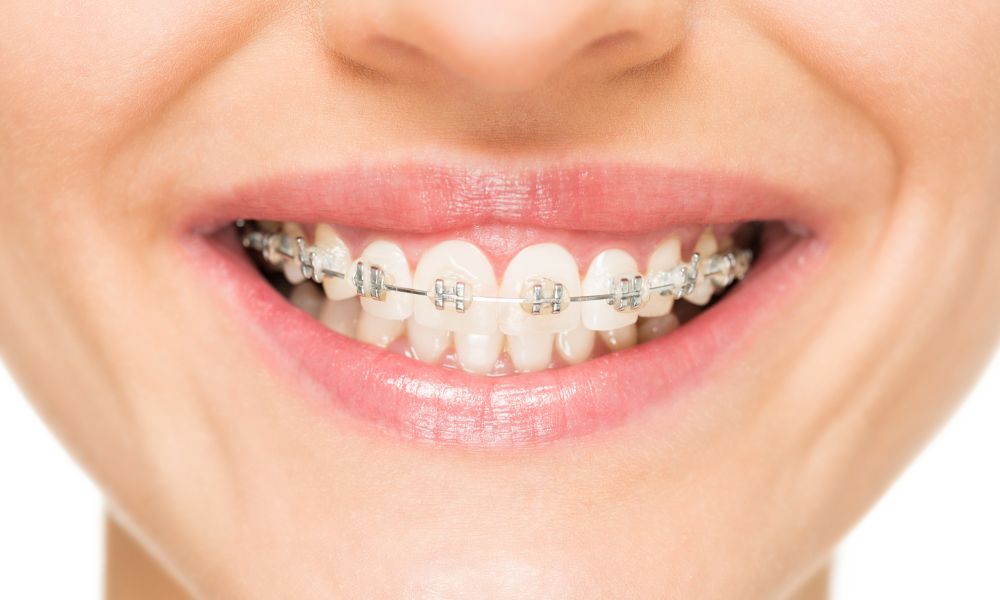 Comparación entre brackets de porcelana y otros tipos de ortodoncia estética