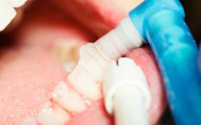 Curetaje dental: Procedimiento y recuperación