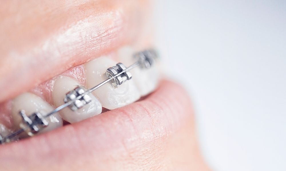 Qué son los brackets de porcelana