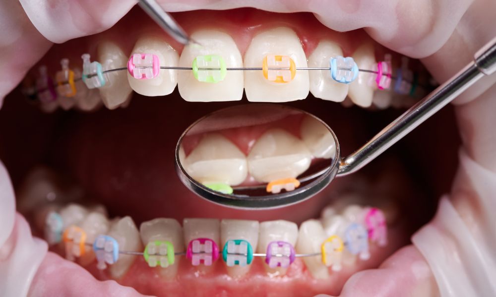 Importancia de la limpieza dental durante el tratamiento de ortodoncia