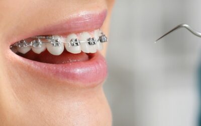 Descubre los Beneficios de Brackets Autoligables