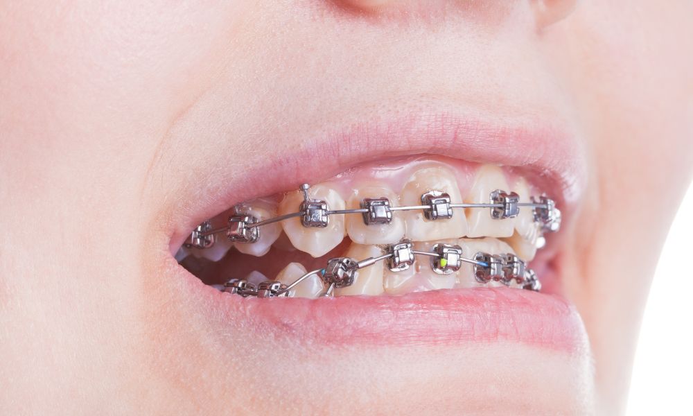 Innovaciones en ortodoncia: brackets autoligables