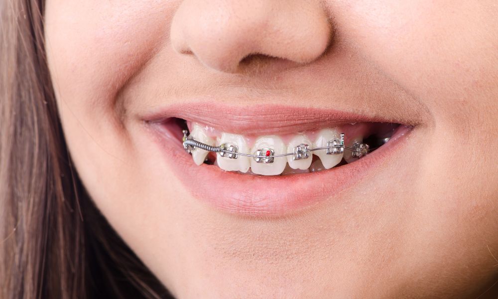 Los Brackets Autoligables: Combina Estética y Comodidad