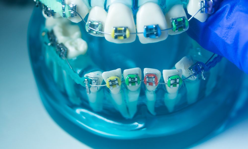 Diferencia entre brackets metálicos y cerámicos